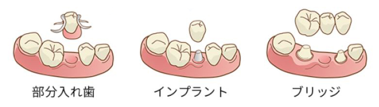 残根の治療または抜歯の治療