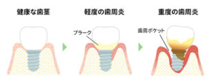 インプラント歯周炎