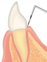 歯茎の検査