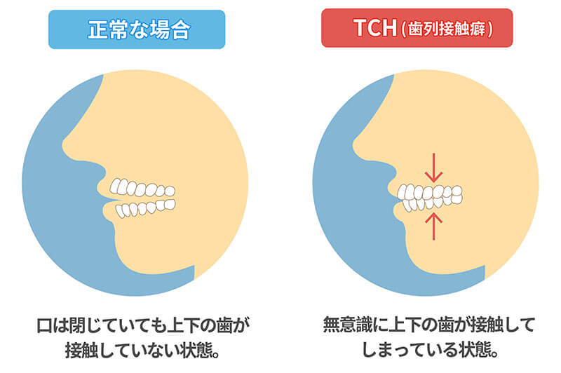 TCH